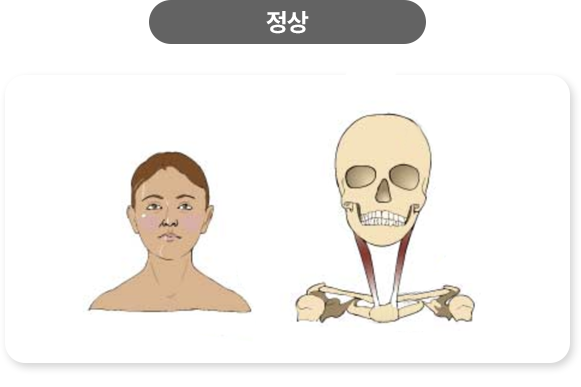 사경 원인과 증상-정상이미지